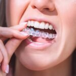 First Time Considering Invisalign in Singapore Here’s What the Cost Really Includes