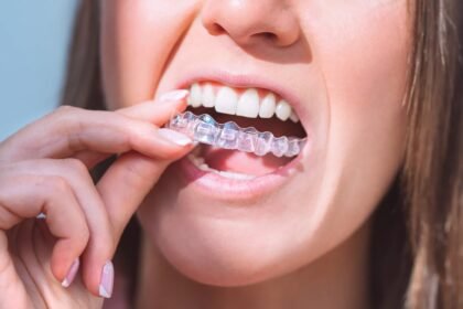 First Time Considering Invisalign in Singapore Here’s What the Cost Really Includes